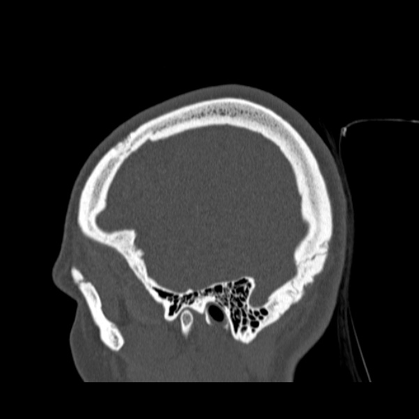 Calvarial osteoma (Radiopaedia 36520-38079 Sagittal bone window 91).jpg