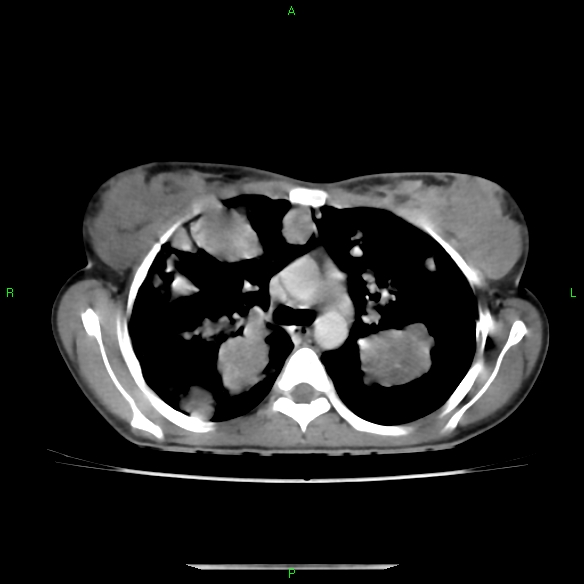File:Cannon ball metastases - synovial sarcoma (Radiopaedia 26135-26271 C 14).jpg