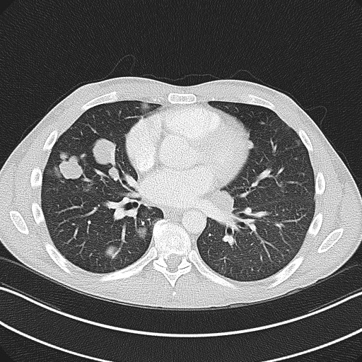 Cannonball metastases - testicular choriocarcinoma (Radiopaedia 84510-99891 Axial lung window 56).jpg