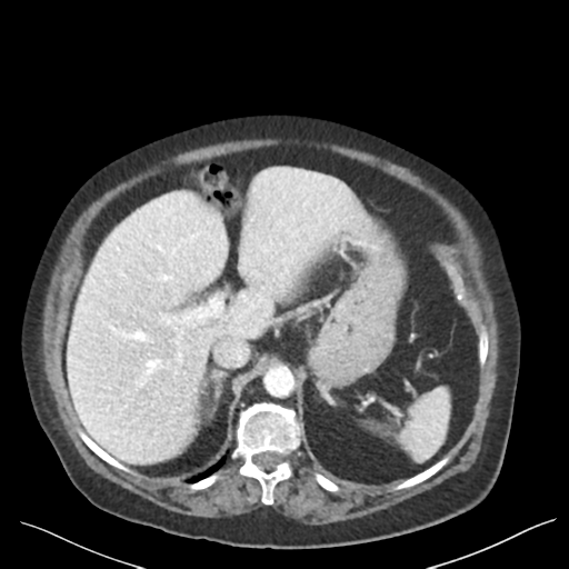 Cannonball metastases from endometrial cancer (Radiopaedia 42003-45031 E 23).png