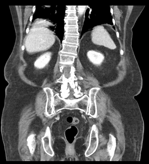Cannonball metastases from endometrial cancer (Radiopaedia 42003-45031 F 48).png