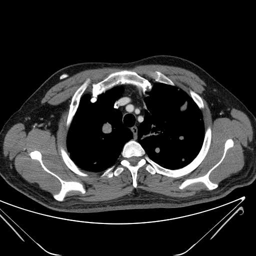 File:Cannonball pulmonary metastases (Radiopaedia 67684-77101 D 66).jpg