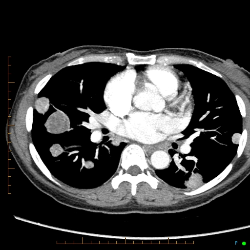 Canonball lung metastasis (Radiopaedia 77634-89837 B 51).jpg