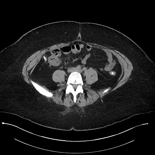 File:Carcinoid tumor - terminal ileum (Radiopaedia 60931-68740 Axial non-contrast 74).jpg