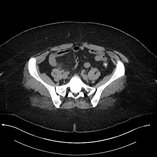 Carcinoid tumor - terminal ileum (Radiopaedia 60931-68740 Axial non-contrast 85).jpg