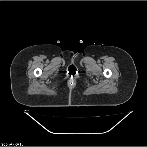 Carcinoma cervix- brachytherapy applicator (Radiopaedia 33135-34173 Axial non-contrast 57).jpg