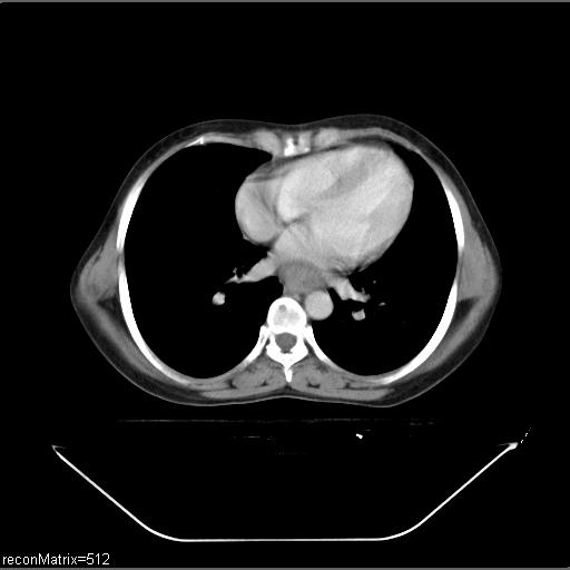 File:Carcinoma of esophagus (Radiopaedia 27356-27550 A 15).jpg