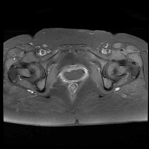 File:Carcinoma of the cervix (Radiopaedia 89018-105858 Axial T1 C+ fat sat 14).jpg