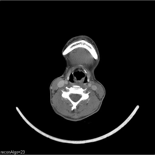 Carcinoma of the maxillary antrum (Radiopaedia 53805-59888 Axial C+ delayed 23).jpg