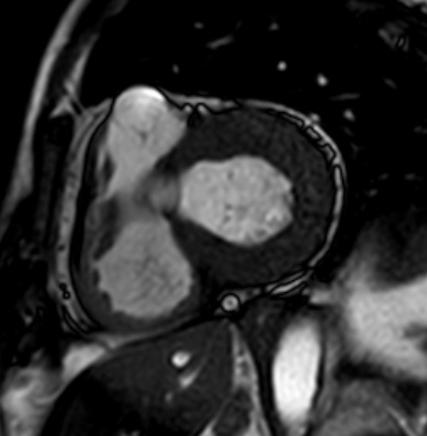 Cardiac amyloidosis - ATTR wild-type (Radiopaedia 74412-85296 short axis cine SSFP 136).jpg