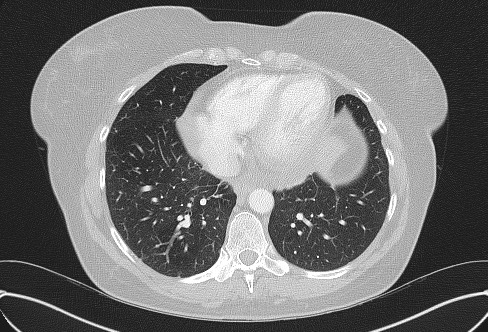 File:Cardiac sarcoidosis (Radiopaedia 74548-85534 Axial lung window 64).jpg