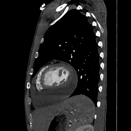 Cardiac tumor - undifferentiated pleomorphic sarcoma (Radiopaedia 45844-50134 B 17).png