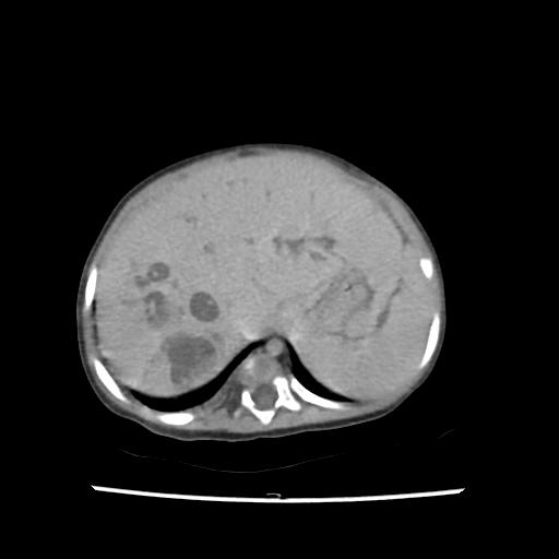 Caroli disease with autosomal recessive polycystic kidney disease (ARPKD) (Radiopaedia 89651-106703 B 36).jpg
