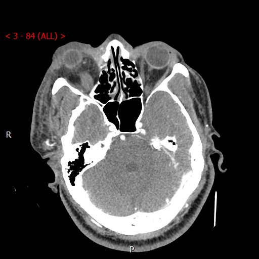 Caroticocavernous fistula (Radiopaedia 42346-45457 B 15).jpg