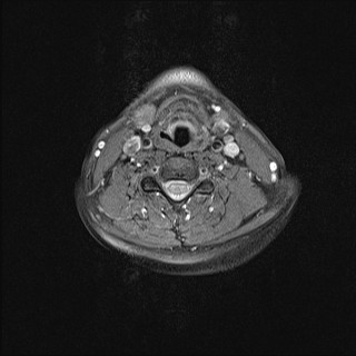 File:Carotid artery dissection (Radiopaedia 28441-28689 Axial T1 fat sat 19).jpg