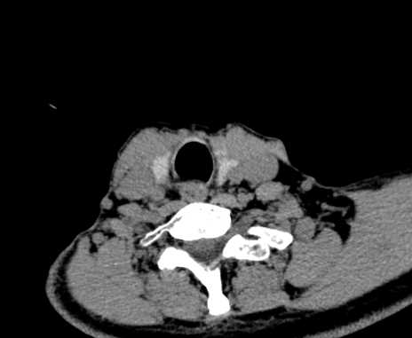 File:Carotid body tumor (Radiopaedia 61750-69757 Axial non-contrast 92).jpg