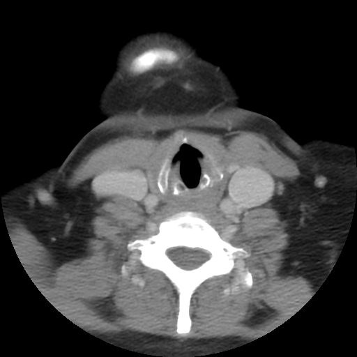 File:Carotid body tumor (paraganglioma) (Radiopaedia 38586-40729 A 24).jpg