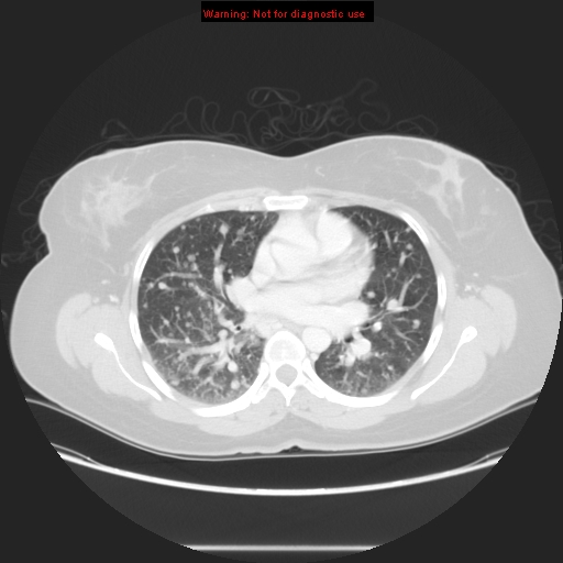 Carotid body tumor with lung metastases (Radiopaedia 9301-48390 Axial lung window 37).jpg