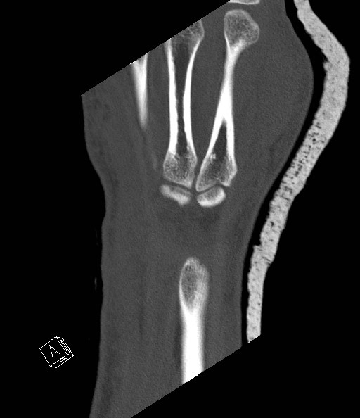 File:Carpal fractures (smart watch impaction) (Radiopaedia 55844-62430 Coronal bone window 3).jpg