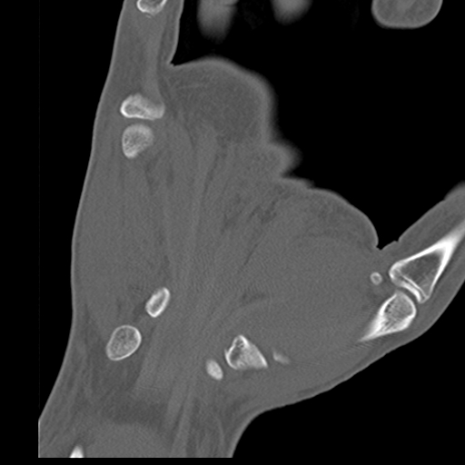 File:Carpo-metacarpal fracture-dislocations with hamatum split fracture (Radiopaedia 18482-18343 Coronal bone window 17).jpg