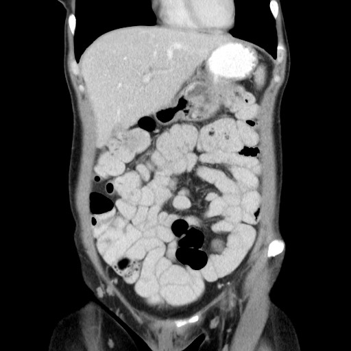 Castleman disease with fibrous pseudotumor in the abdomen (Radiopaedia 77296-89373 B 26).jpg
