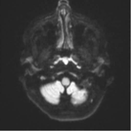 File:Cavernoma with bleed - midbrain (Radiopaedia 54546-60774 Axial DWI 30).png
