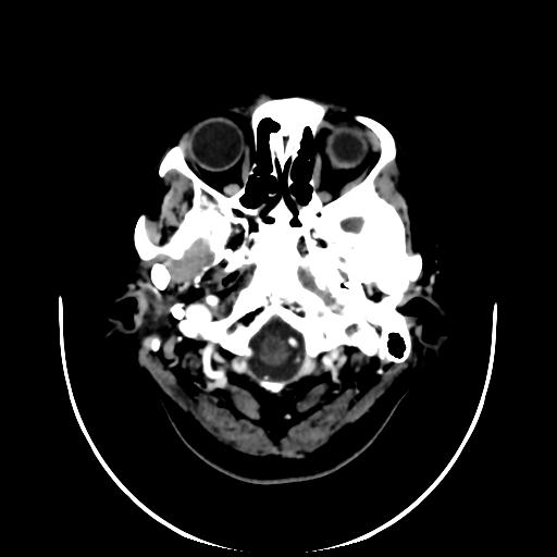 File:Cavernoma with developmental venous anomaly (Radiopaedia 22470-22506 C+ arterial phase 1).jpg