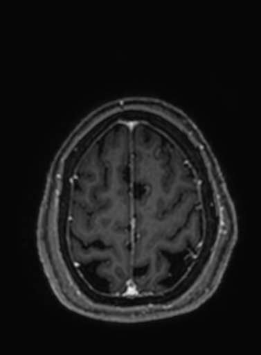 Cavernous hemangioma of the cerebellar falx (Radiopaedia 73025-83724 Axial T1 C+ 61).jpg