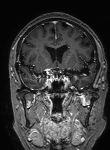 Cavernous hemangioma of the cerebellar falx (Radiopaedia 73025-83724 Coronal T1 C+ 151).jpg