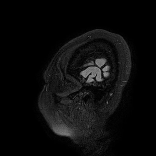 Cavernous hemangioma of the cerebellar falx (Radiopaedia 73025-83724 Sagittal FLAIR 1).jpg
