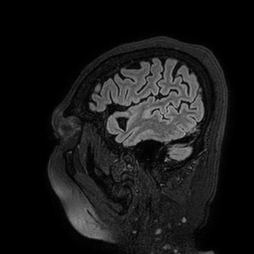 File:Cavernous hemangioma of the cerebellar falx (Radiopaedia 73025-83724 Sagittal FLAIR 24).jpg