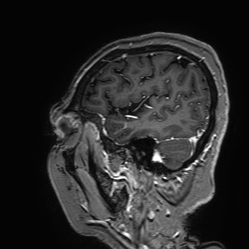 File:Cavernous hemangioma of the cerebellar falx (Radiopaedia 73025-83724 Sagittal T1 C+ 172).jpg