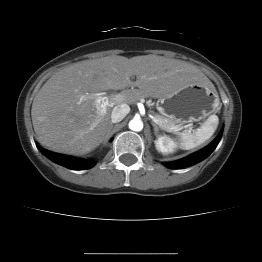 Cavernous hepatic hemangioma (Radiopaedia 75441-86667 A 33).jpg