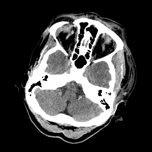 File:Cavernous sinus thrombosis (Radiopaedia 10619-11078 Axial non-contrast 9).jpg