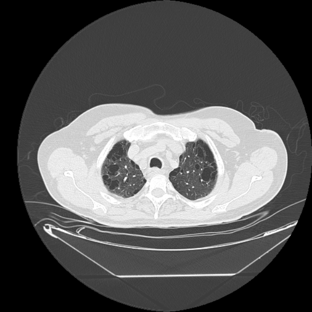 Cavitating bronchogenic carcinoma (Radiopaedia 44489-48162 Axial lung window 11).jpg