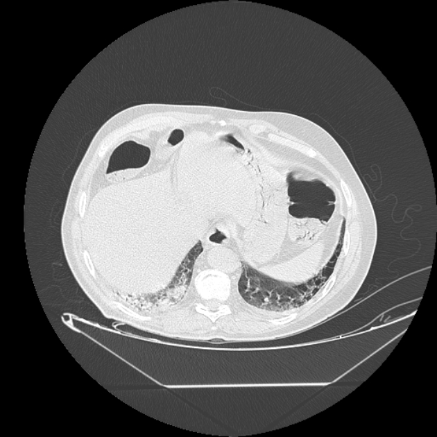 Cavitating bronchogenic carcinoma (Radiopaedia 44489-48162 Axial lung window 74).jpg