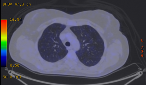 File:Cavitating lung mass - squamous cell carcinoma (Radiopaedia 48047-52853 A 31).png