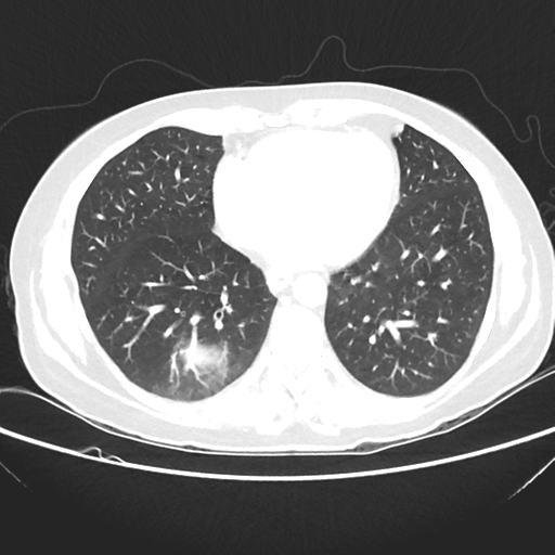 File:Cavitating lung mass - squamous cell carcinoma (Radiopaedia 48047-52854 Axial lung window 33).png