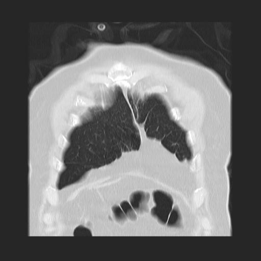File:Cavitating pulmonary metastases (Radiopaedia 89545-106544 Coronal lung window 6).jpg