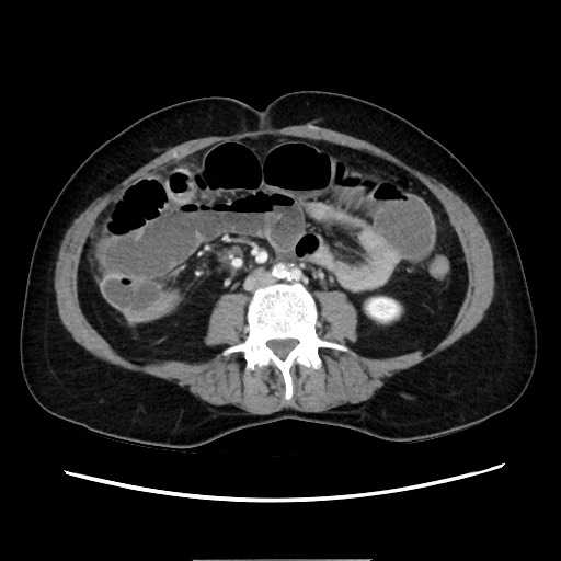 Cecal adenocarcinoma (Radiopaedia 75909-87331 A 51).jpg