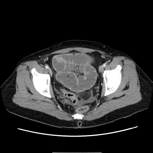 Cecal adenocarcinoma (Radiopaedia 75909-87331 A 78).jpg