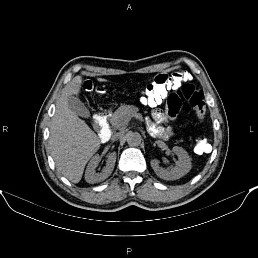 Cecal adenocarcinoma (Radiopaedia 85324-100916 Axial non-contrast 29).jpg