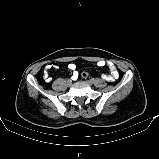 Cecal adenocarcinoma (Radiopaedia 85324-100916 Axial non-contrast 69).jpg