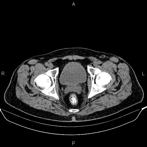 Cecal adenocarcinoma (Radiopaedia 85324-100916 Axial non-contrast 95).jpg