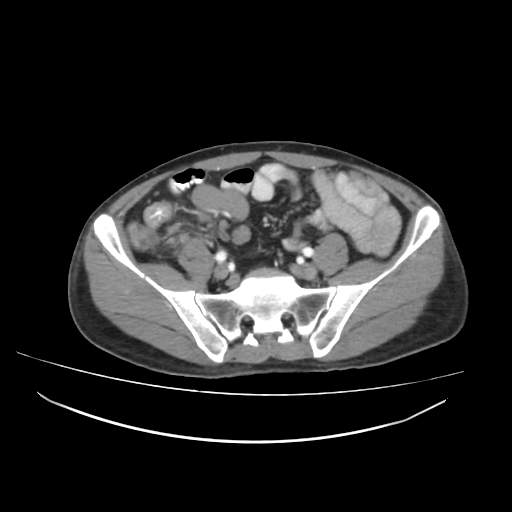 Cecal carcinoma with local lymphadenopathy (Radiopaedia 31428-32240 A 38).jpg