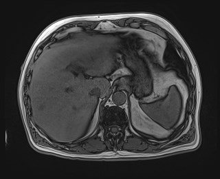 Cecal mass causing appendicitis (Radiopaedia 59207-66532 D 32).jpg