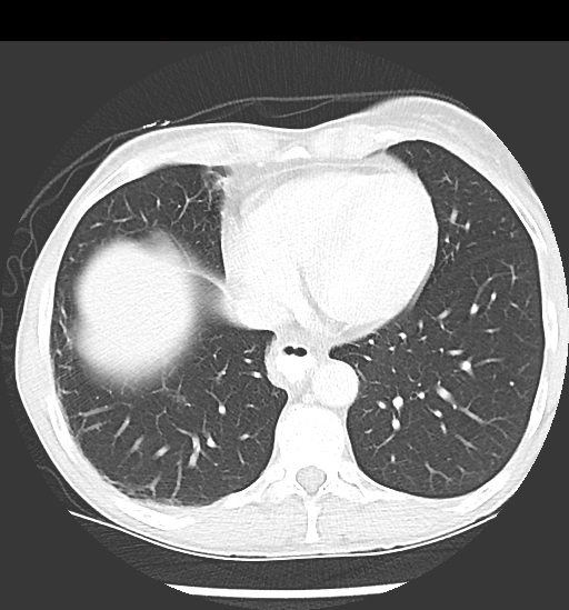 File:Cecal volvulus (Radiopaedia 48543-53513 Axial lung window 7).jpg