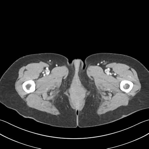 Cecum hernia through the foramen of Winslow (Radiopaedia 46634-51112 A 84).png