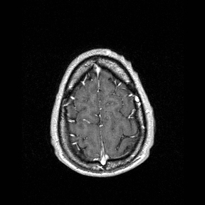 Central-variant posterior reversible encephalopathy syndrome (PRES) (Radiopaedia 43880-47358 Axial T1 C+ 151).jpg