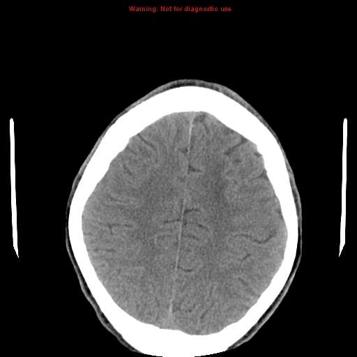 File:Central nervous system vasculitis (Radiopaedia 8410-9234 Axial non-contrast 21).jpg